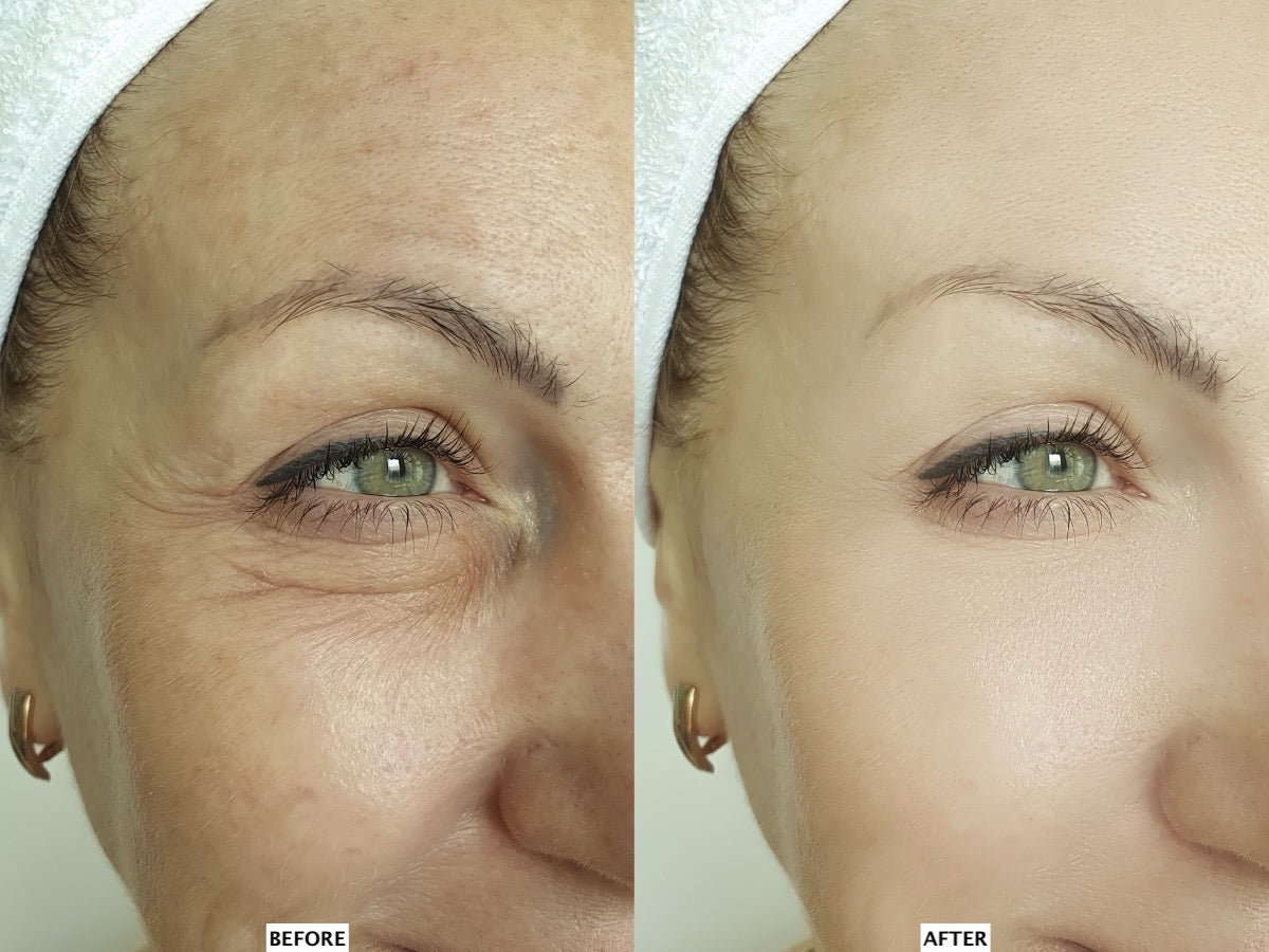 Leaf Fusion Plasma device before and after